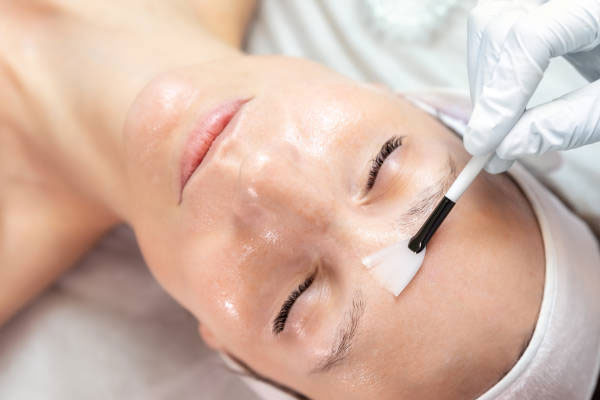 Kimyasal Peeling Tedavisi